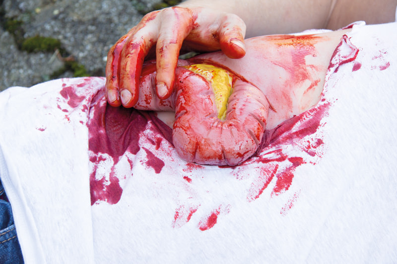 WUNDMOULAGE DICKDARMAUSTRITT WUNDMOULAGE DICKDARMAUSTRITT