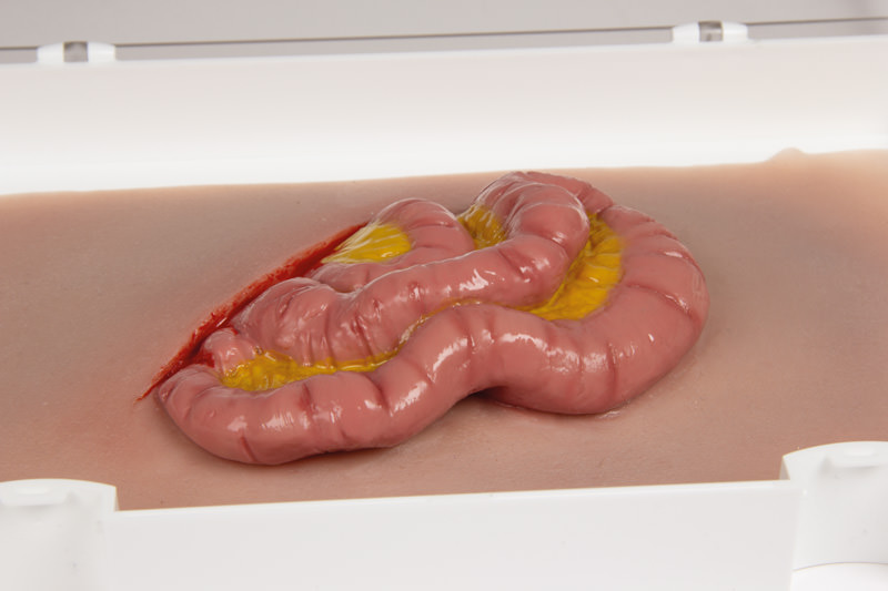 WUNDMOULAGE DÜNNDARMAUSTRITT WUNDMOULAGE DÜNNDARMAUSTRITT