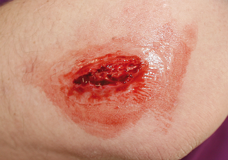 EZ WOUNDS WUNDENSIMULATIONSSET „PROFESSIONAL“ EZ WOUNDS WUNDENSIMULATIONSSET „PROFESSIONAL“
