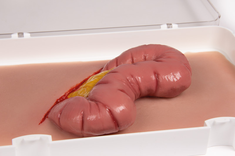 WUNDMOULAGE DICKDARMAUSTRITT WUNDMOULAGE DICKDARMAUSTRITT