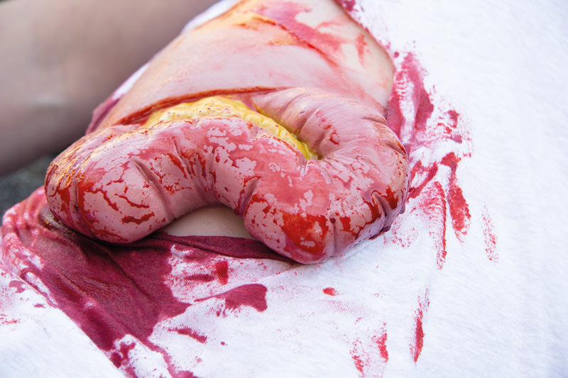 WUNDMOULAGE DICKDARMAUSTRITT WUNDMOULAGE DICKDARMAUSTRITT