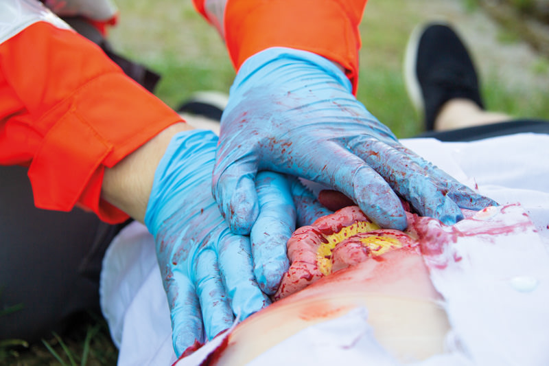 WUNDMOULAGE DÜNNDARMAUSTRITT WUNDMOULAGE DÜNNDARMAUSTRITT