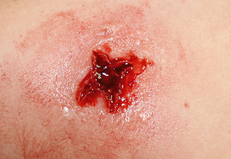 EZ WOUNDS WUNDENSIMULATIONSSET „PROFESSIONAL“ EZ WOUNDS WUNDENSIMULATIONSSET „PROFESSIONAL“