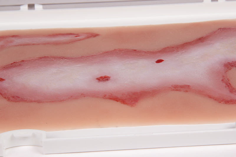 WUNDMOULAGE VERBRÜHUNG WUNDMOULAGE VERBRÜHUNG