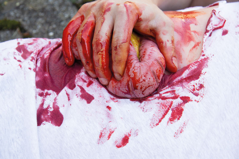 WUNDMOULAGE DICKDARMAUSTRITT WUNDMOULAGE DICKDARMAUSTRITT