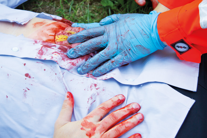 WUNDMOULAGE DÜNNDARMAUSTRITT WUNDMOULAGE DÜNNDARMAUSTRITT