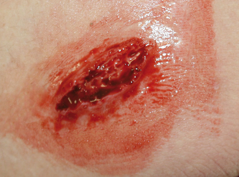 EZ WOUNDS – WUNDENSIMULATION FÜR SIMULATIONSPATIENTEN EZ WOUNDS – WUNDENSIMULATION FÜR SIMULATIONSPATIENTEN