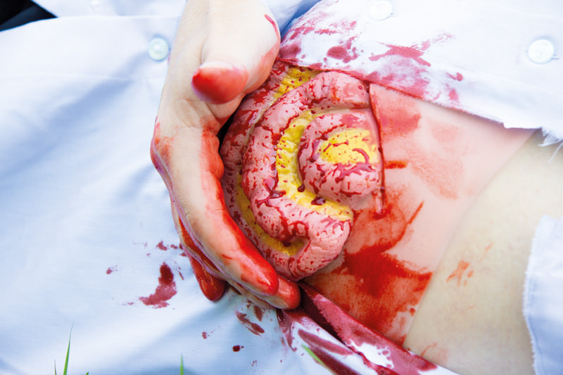 WUNDMOULAGE DÜNNDARMAUSTRITT WUNDMOULAGE DÜNNDARMAUSTRITT