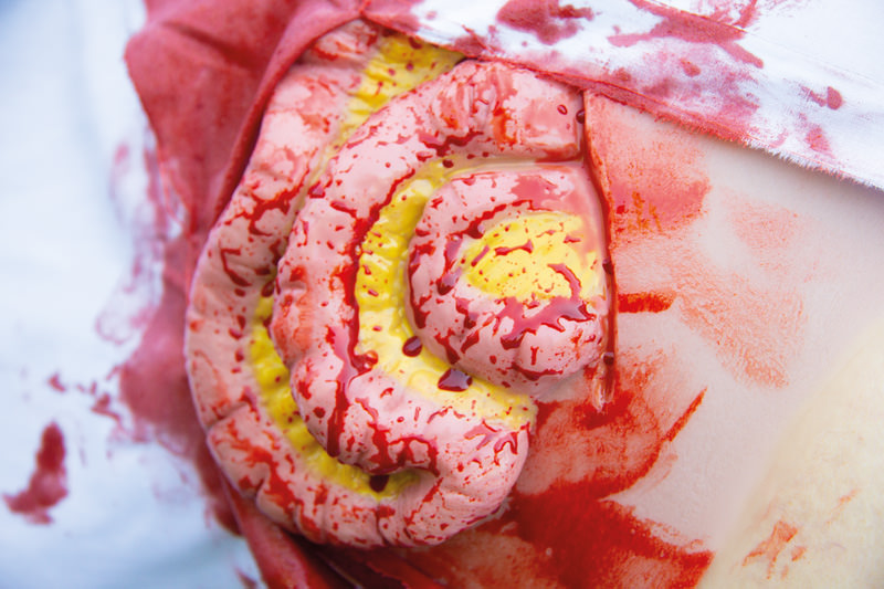 WUNDMOULAGE DÜNNDARMAUSTRITT WUNDMOULAGE DÜNNDARMAUSTRITT