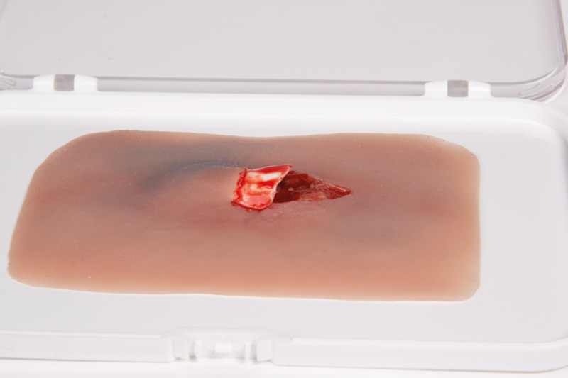 WUNDMOULAGE OFFENER KNOCHENBRUCH WUNDMOULAGE OFFENER KNOCHENBRUCH