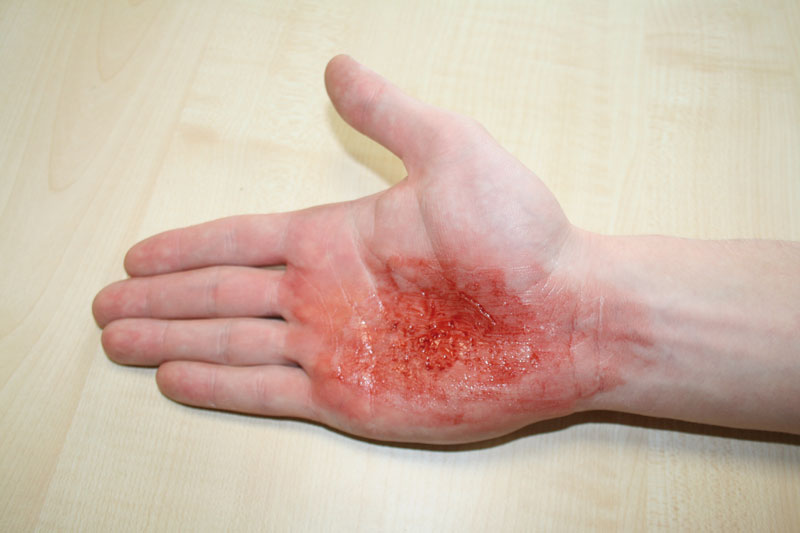 EZ WOUNDS – WUNDENSIMULATION FÜR SIMULATIONSPATIENTEN EZ WOUNDS – WUNDENSIMULATION FÜR SIMULATIONSPATIENTEN