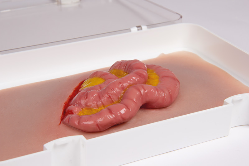 WUNDMOULAGE DÜNNDARMAUSTRITT WUNDMOULAGE DÜNNDARMAUSTRITT