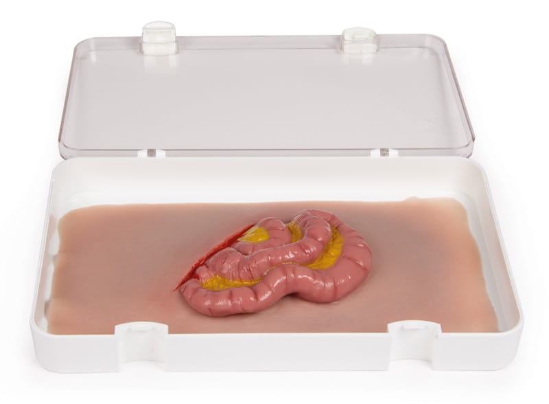 WUNDMOULAGE DÜNNDARMAUSTRITT WUNDMOULAGE DÜNNDARMAUSTRITT