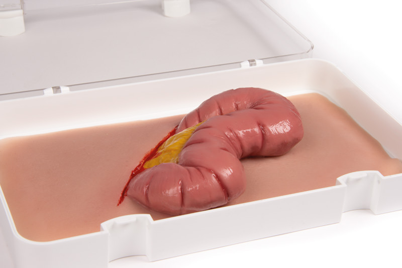 WUNDMOULAGE DICKDARMAUSTRITT WUNDMOULAGE DICKDARMAUSTRITT